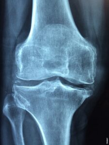 Pročitajte više o članku Simptomi i liječenje osteoporoze