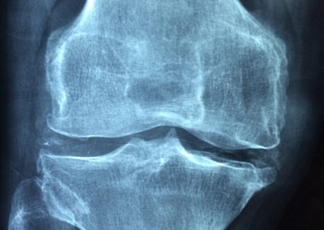 Simptomi i liječenje osteoporoze
