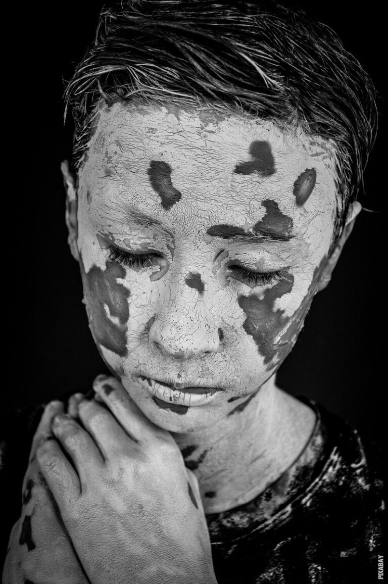 Pročitajte više o članku Šta je vitiligo i kako nastaje