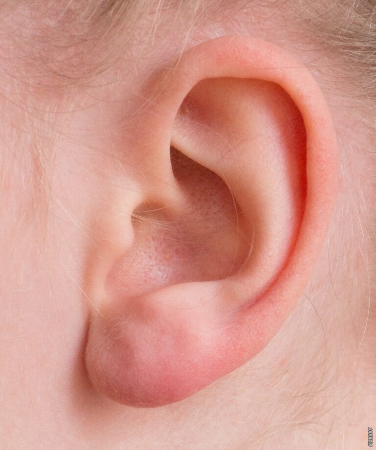 Pročitajte više o članku Zašto su uši vruće?